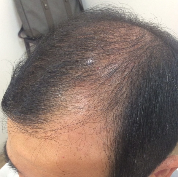 Hair Farm -幹細胞培養液-   福岡市南区高宮　育毛　発毛サロン　toushel YAMAGUCHI
